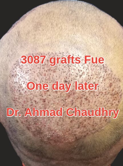 3087 grafts after hair restoration Pakistan