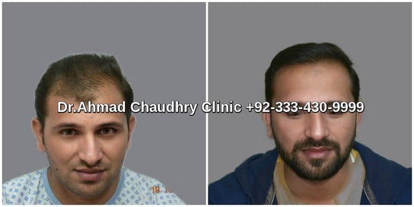 Before after hair transplant result Pakistan