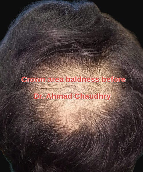 Crown baldness Pakistan
