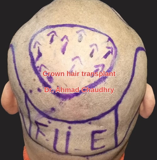 Fue hair transplant South Africa
