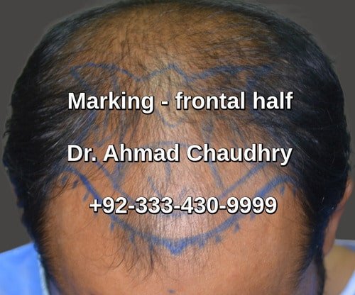 Hair replacement Pakistan