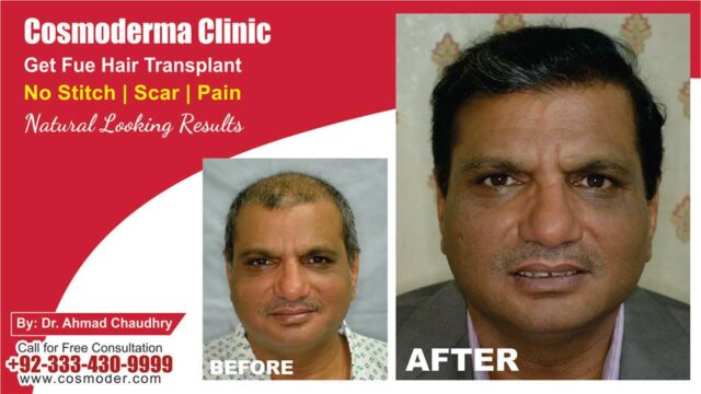 Hair replacement advice Lahore Pakistan