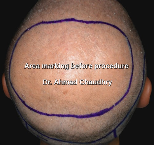 Hair transplant Italy patient