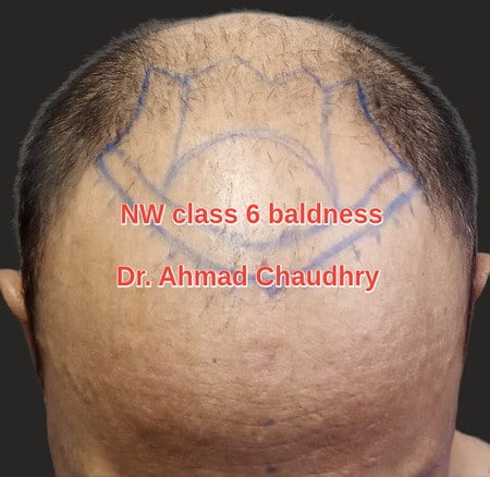 Hair transplant Lahore Prices