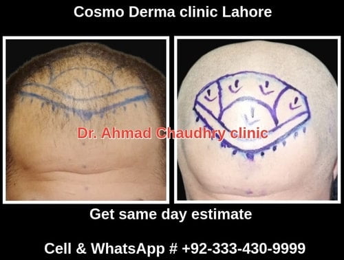 Hair transplant Layyah patient