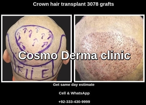 Hair transplant therapy South Africa