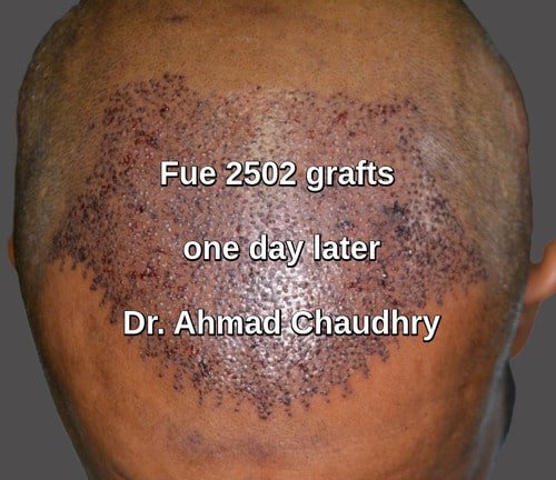 Surgical hair replacement Lahore