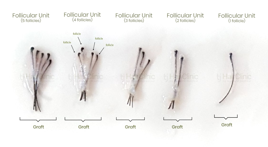 Two hairs in one follicle | Importance in hair transplant transplant Two hairs in one follicle | Importance in hair transplant transplant