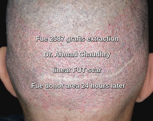 Fue donor area 2587 grafts extraction