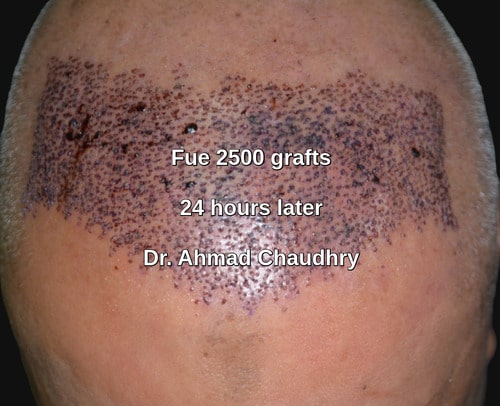 Fue hair restoration South Africa patient