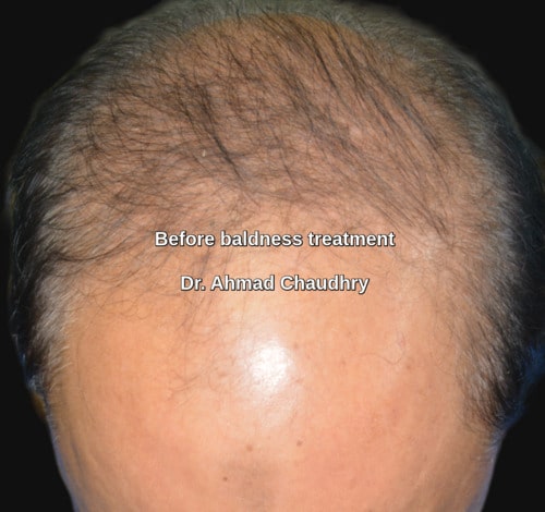Pattern baldness treatment Lahore