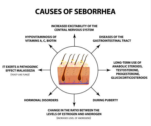 Seborrhea causes
