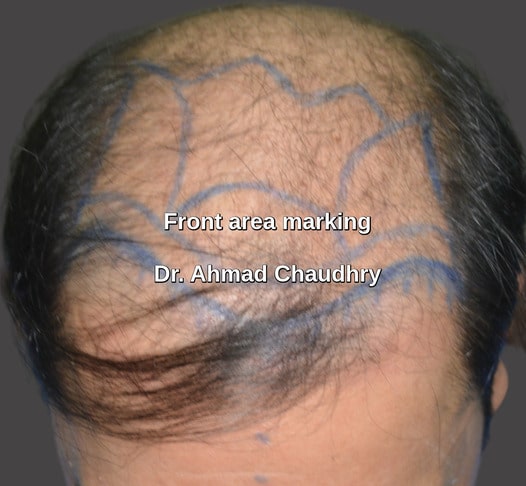 Baldness area marking Texas patient