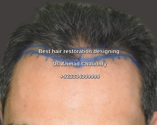 Best hair restoration surgery designing