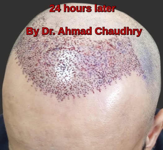 Best hair transplant Lahore Sukh Chayn gardens