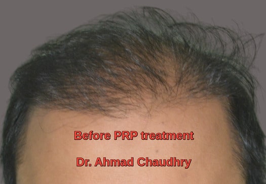 PRP hair loss treatment Lahore Pakistan