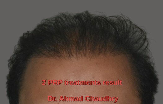 Two PRP hair loss treatments result Lahore