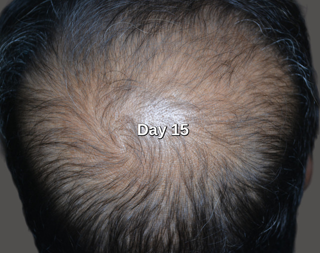 15 days later stem cell treatment results