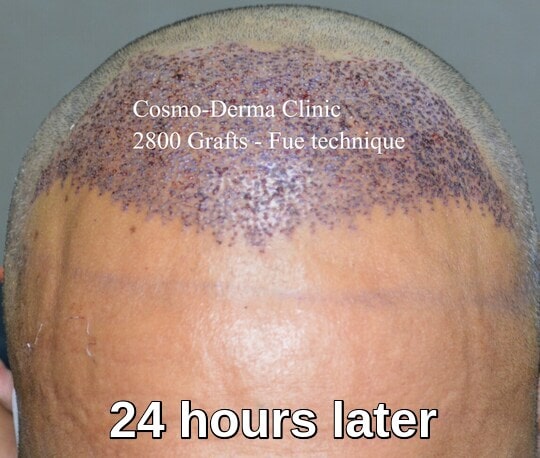 2800 grafts hair restoration Lahore 24 hours later