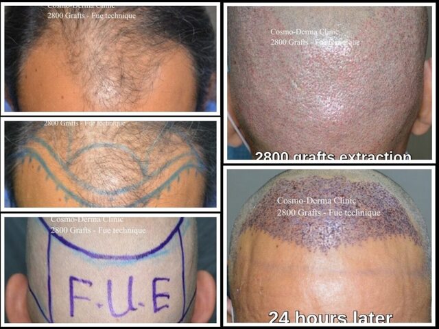 2801 grafts before after photos Lahore Pakistan