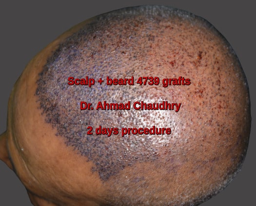 4739 scalp plus beard grafts