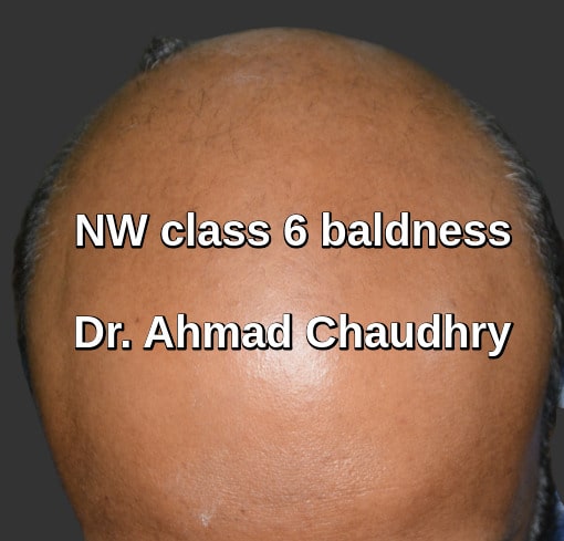 Baldness before treatment Saudi Arab patient