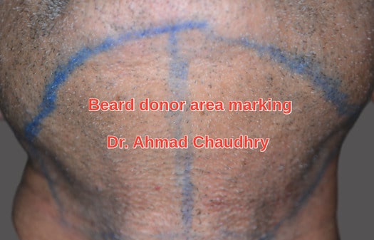 Beard donor area marking preparation
