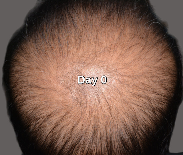 Before stem cell hair loss treatment Lahore Pakistan