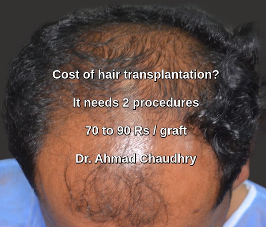 Cost of hair transplantation Lahore Pakistan