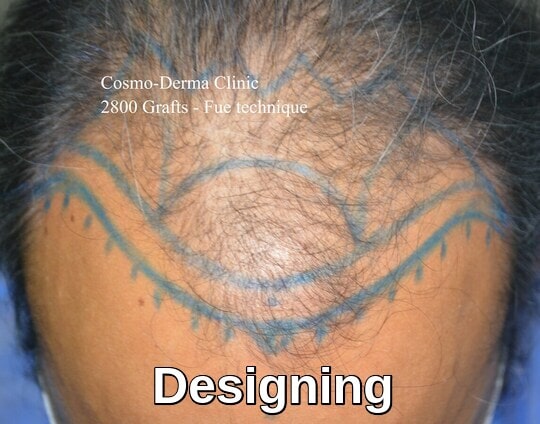 Frontal baldness area marking