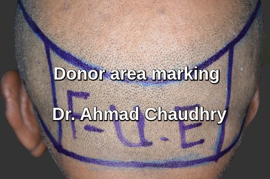 Fue donor area marking Yanbu KSA