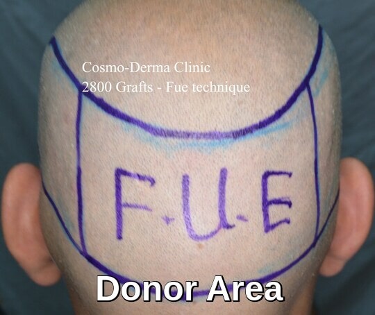 Fue donor area marking