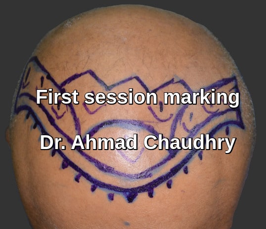 Fue hair transplant Yanbu patient marking