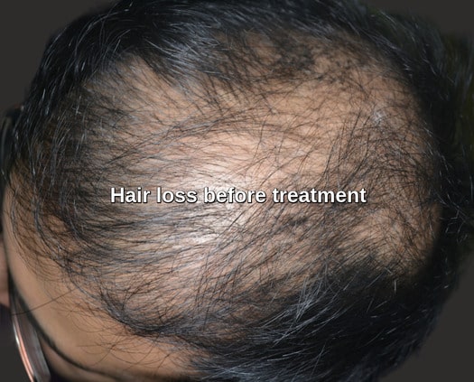 Hair fall treatment Holland patient