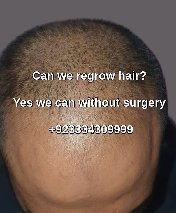 Hair loss specialist clinic Multan patient