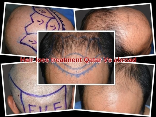 Hair loss treatment Qatar