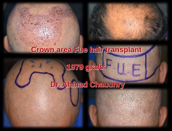 Hair transplant Dubai Abu Dhabi patient