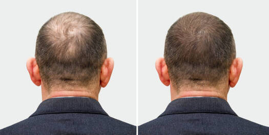 Hair transplant Kuwait cost crown area