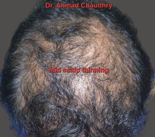 Hair transplant New York patient before