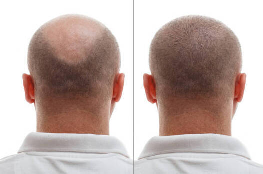 Hair transplant Qatar cost