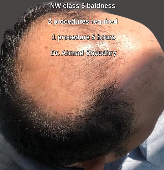 Hair transplant in Daska