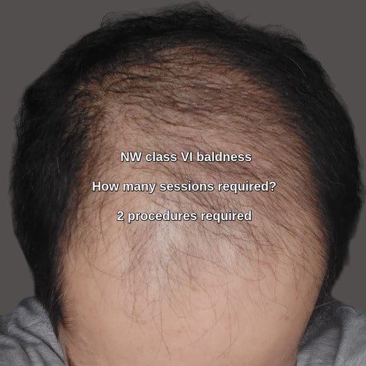 Hair transplant in Germany