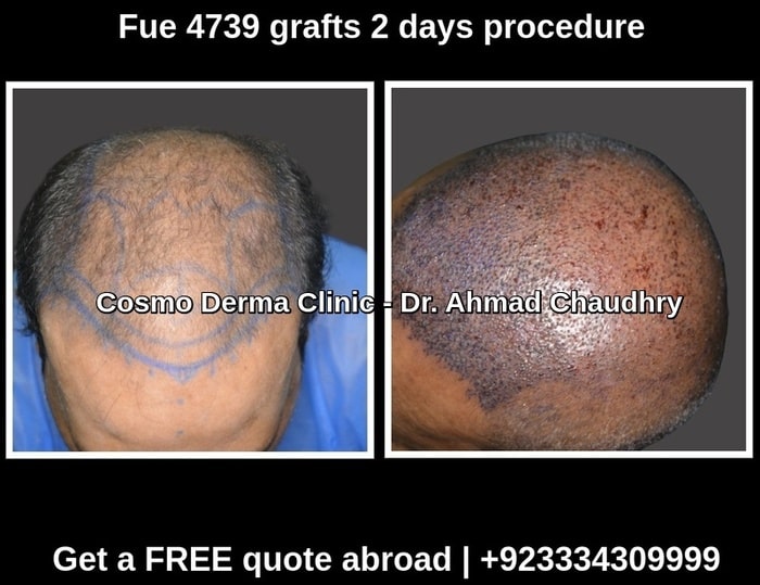 Hair transplantation Oslo patient