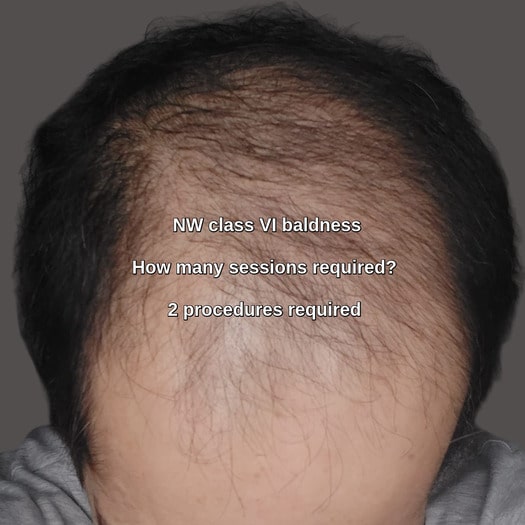 Hair transplants clinic Taif patient
