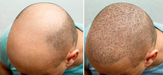 Laser hair restoration before after Lahore