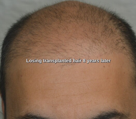 Losing transplanted hair