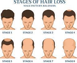 Male pattern baldness