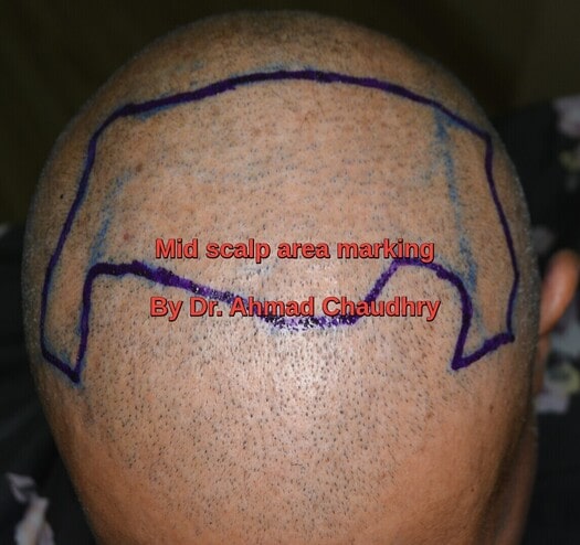 Midscalp zone marking Brooklyn patient