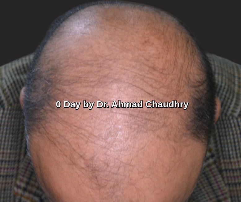 PRF hair regrowth treatment Lahore before