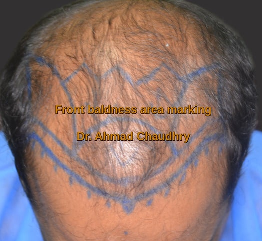 Baldness Harbanspura patient